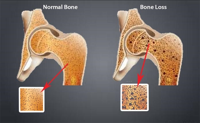 bone loss iamge Sioux Falls Orthopedics
